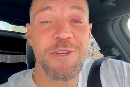 Дзюба показал видео с синяком на глазу