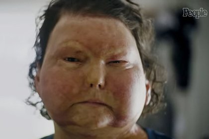 «Я потерял 80 процентов кожи, у меня чужие лицо и руки». Мужчина попал в жуткую аварию и рассказал о загробном мире