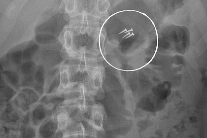 Врачи Склифа показали самые необычные находки в пациентах