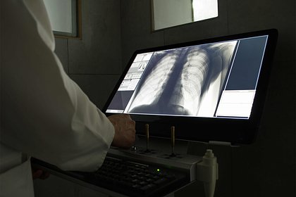 Специалист Минздрава заявил о непригодности флюорографии для защиты от рака легкого