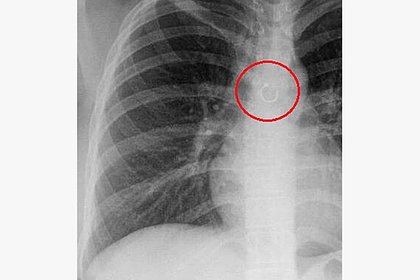 В легком у девушки нашли пирсинг носа